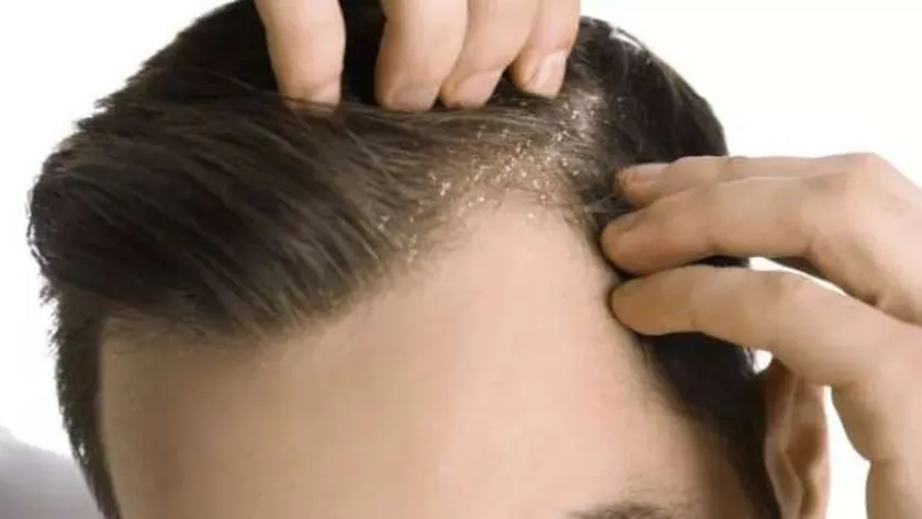 أسباب قشرة الشعر