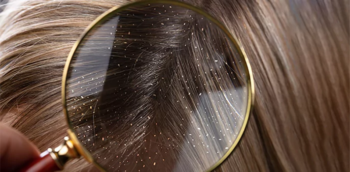 أسباب قشرة الشعر