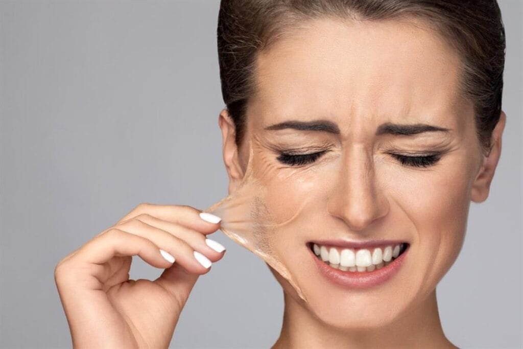 تقشير البشرة الكيميائي