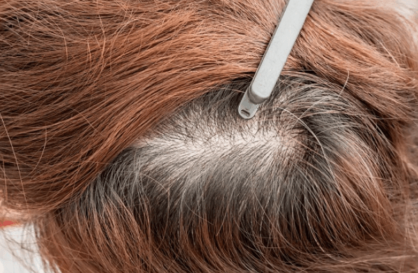 تقصف الشعر عند الأطفال