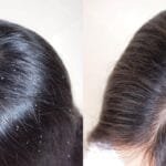 أسباب قشرة الشعر