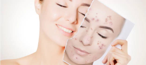 أفضل الطرق لعلاج حب الشباب والتخلص من آثاره 2 علاج حب الشباب