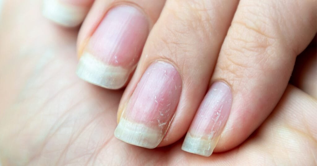 علاج تقصف الأظافر