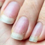 علاج تقصف الأظافر