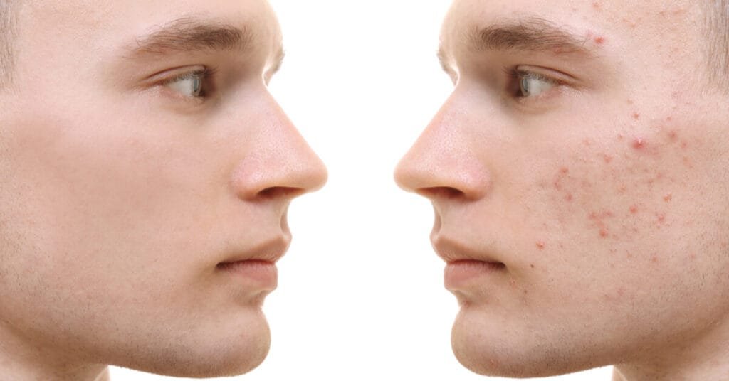 علاج حب الشباب