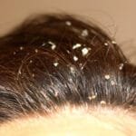 علاج قشرة الشعر بالأعشاب