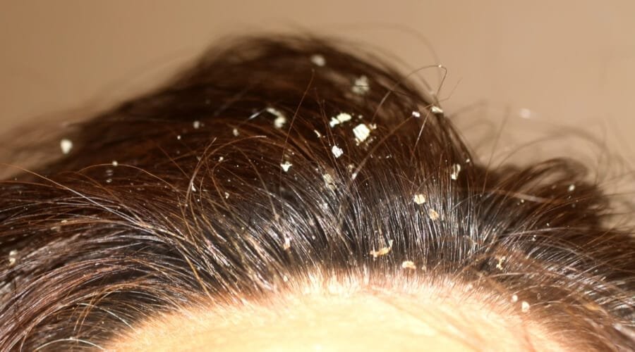 علاج قشرة الشعر بالأعشاب