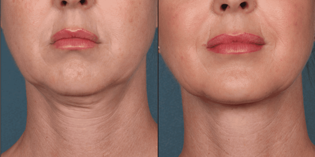 آثار جانبية لحقن الدهون في الشفاه