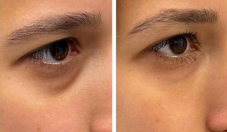 علاج الهالات بالفيلر هل هو الحل المثالي؟ 1 علاج الهالات بالفيلر