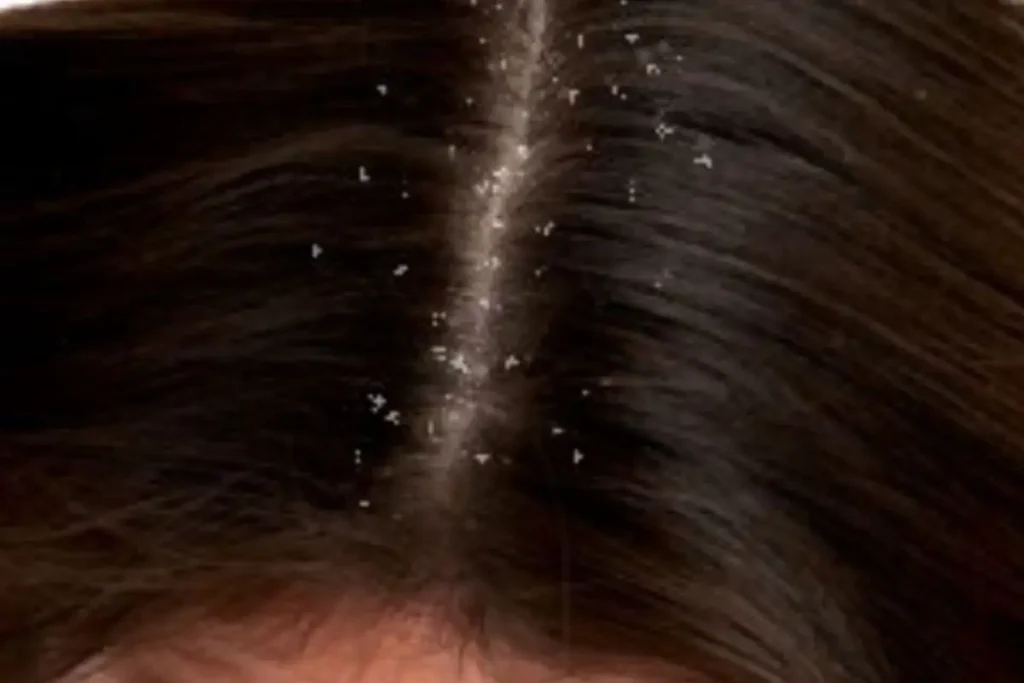 قشرة الشعر الجاف