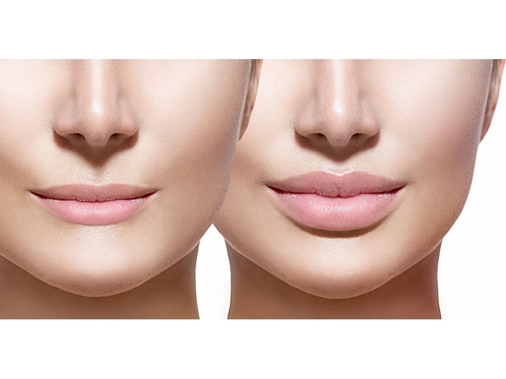 آثار جانبية لحقن الدهون في الشفاه