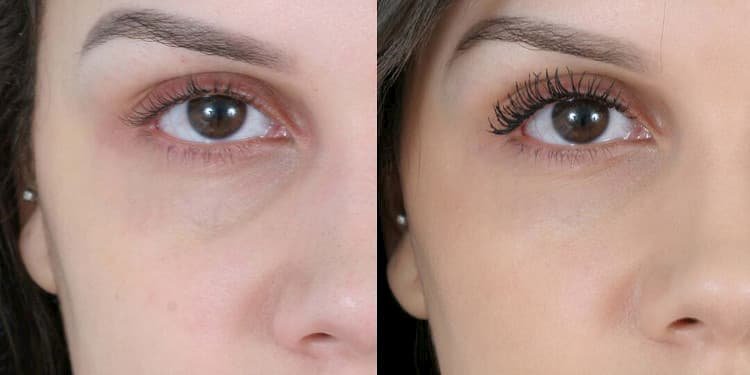 علاج الهالات بالفيلر هل هو الحل المثالي؟ 2 علاج الهالات بالفيلر