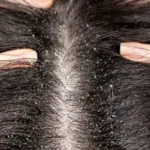 قشرة الشعر الدهني