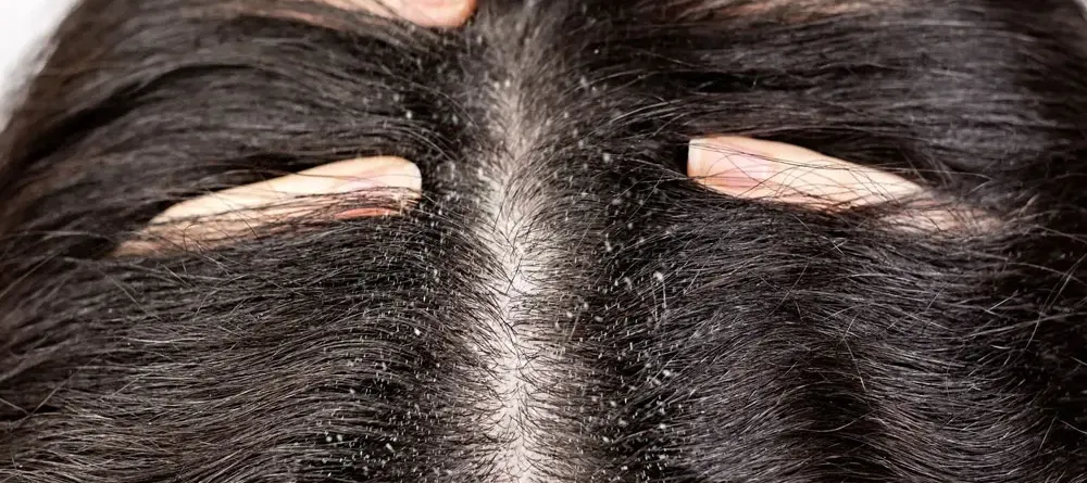 قشرة الشعر الدهني