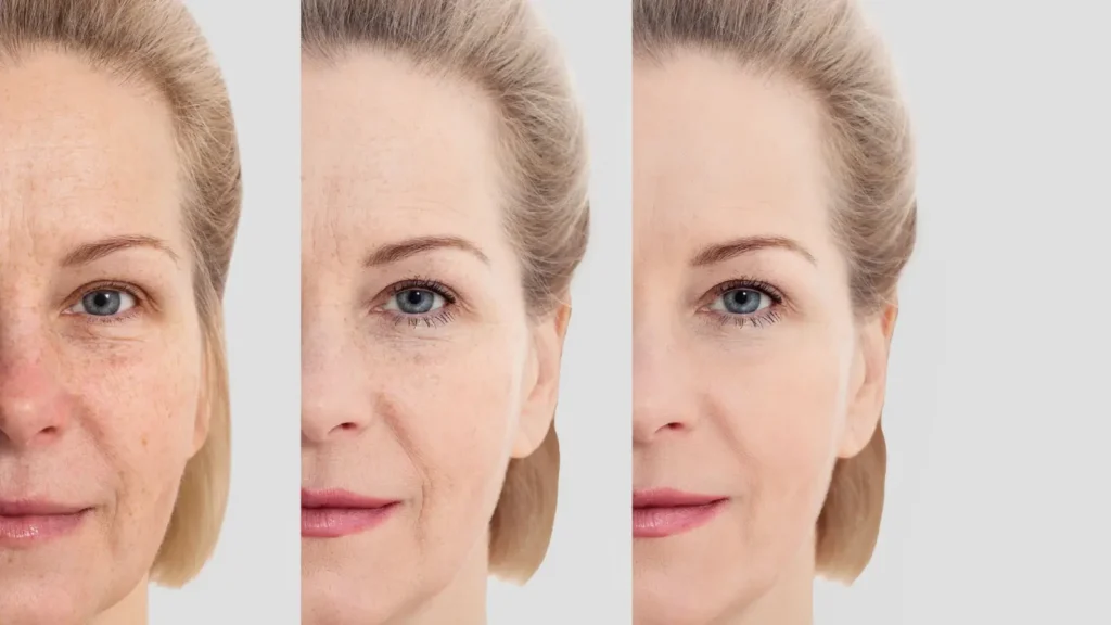 مضاعفات شد الوجه بالليزر