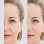 مضاعفات شد الوجه بالليزر