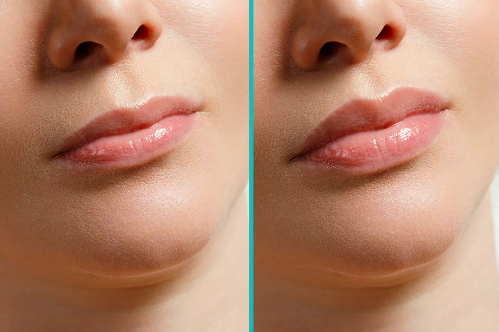 آثار جانبية لعمليات تجميل الشفاه