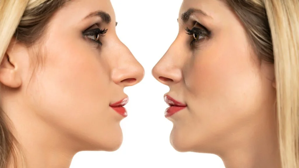 آثار جانبية لعمليات تجميل الشفاه 