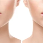 أضرار تكبير الشفاه بالمواد الدائمة