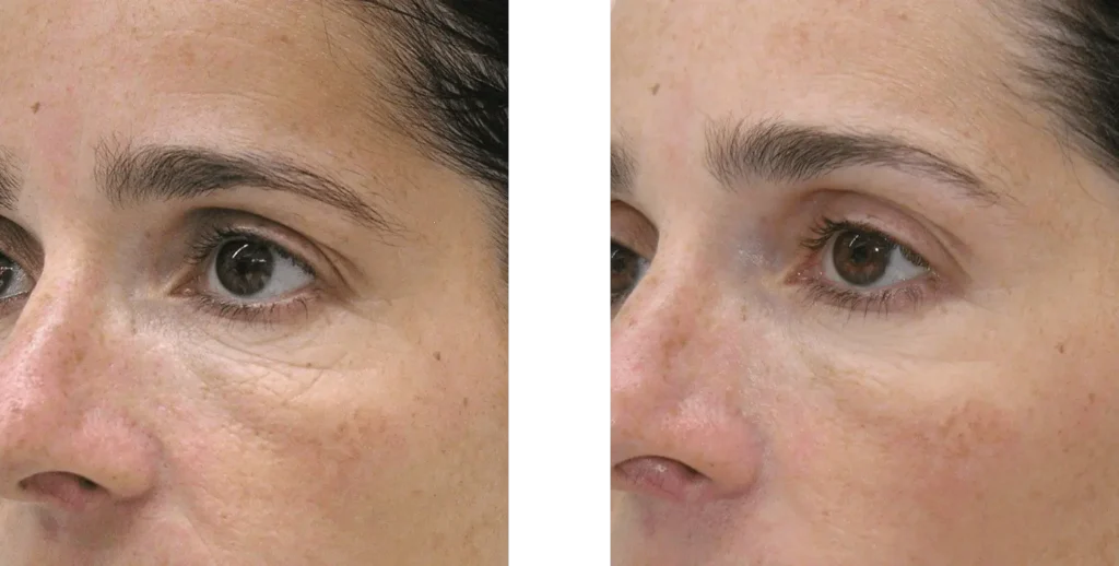 علاج الهالات بالميزوثيرابي