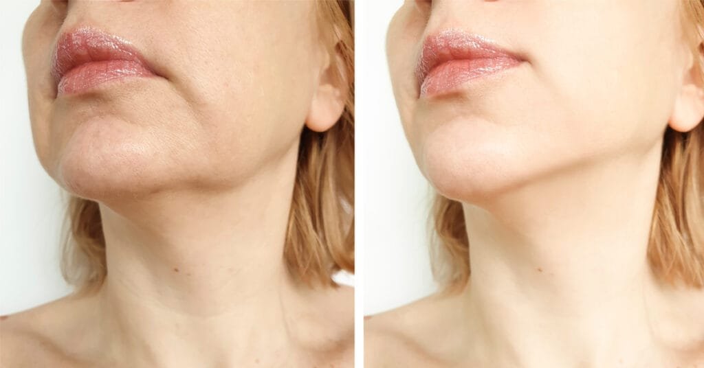 مخاطر شد الوجه باستخدام التقنيات الحرارية