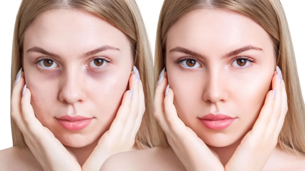 علاج الهالات بالإبر