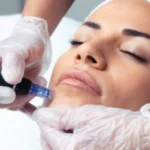 علاج الهالات بالميزوثيرابي