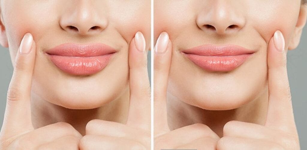 آثار جانبية لعمليات تجميل الشفاه 